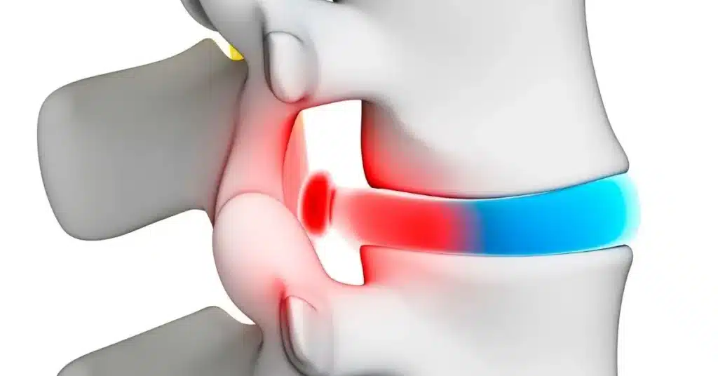 Will a TENS Unit Help a Pinched Nerve - Things to Know